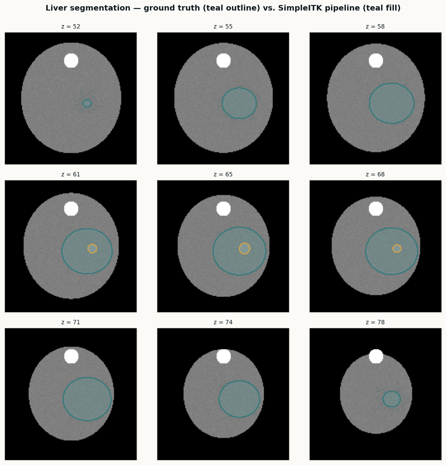 Liver segmentation review: ground truth outline vs. SimpleITK prediction